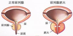 前列腺炎治病期间要注意什么